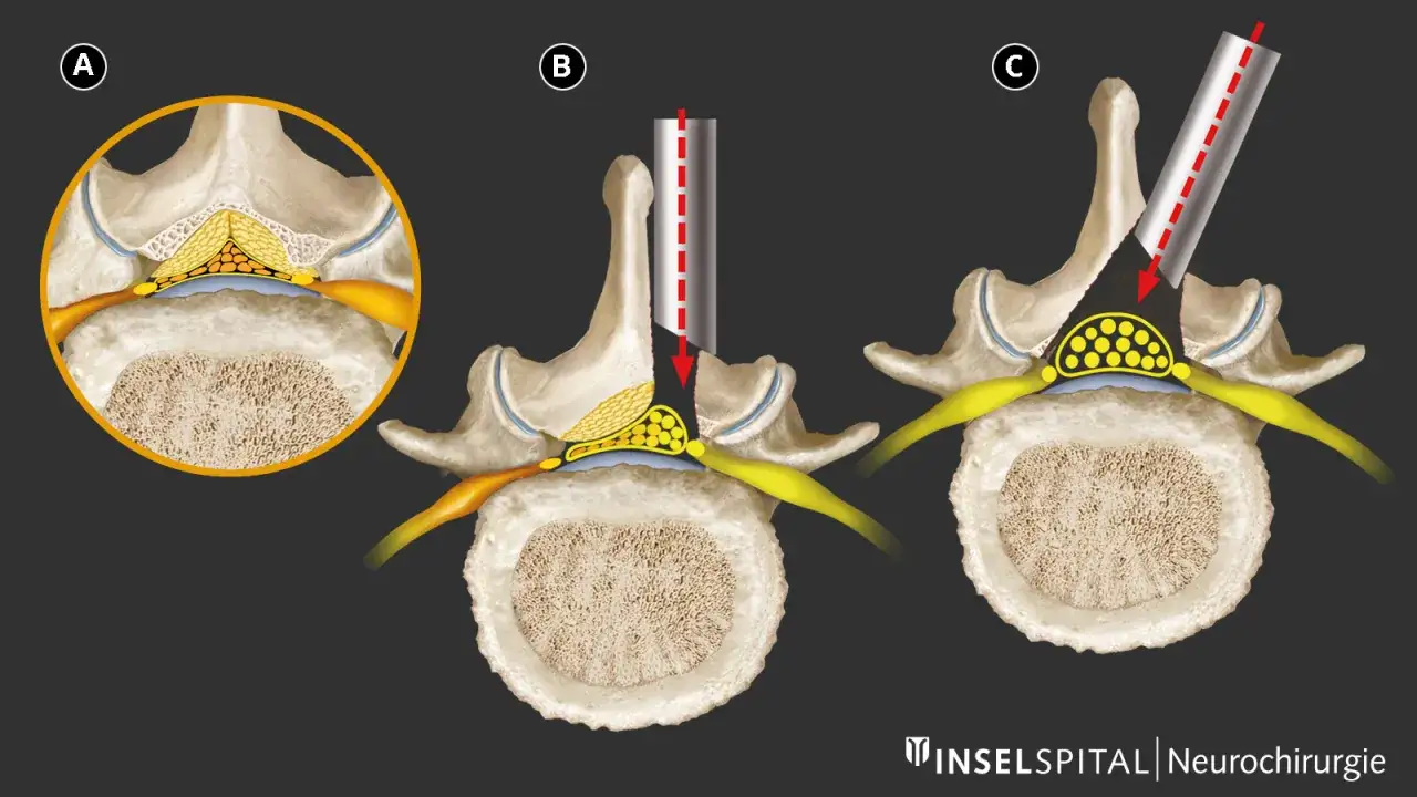 Illustration zeigt die operative Dekompression bei Spinalkanalstenose. Ein Instrument wird eingeführt, um den Druck auf die Nerven zu mindern.