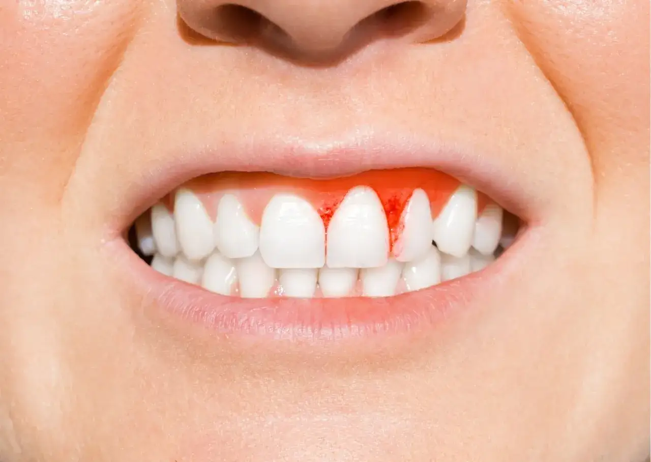 Enc&iacute;as sangrantes, un signo de que la gingivitis es contagiosa al besar.