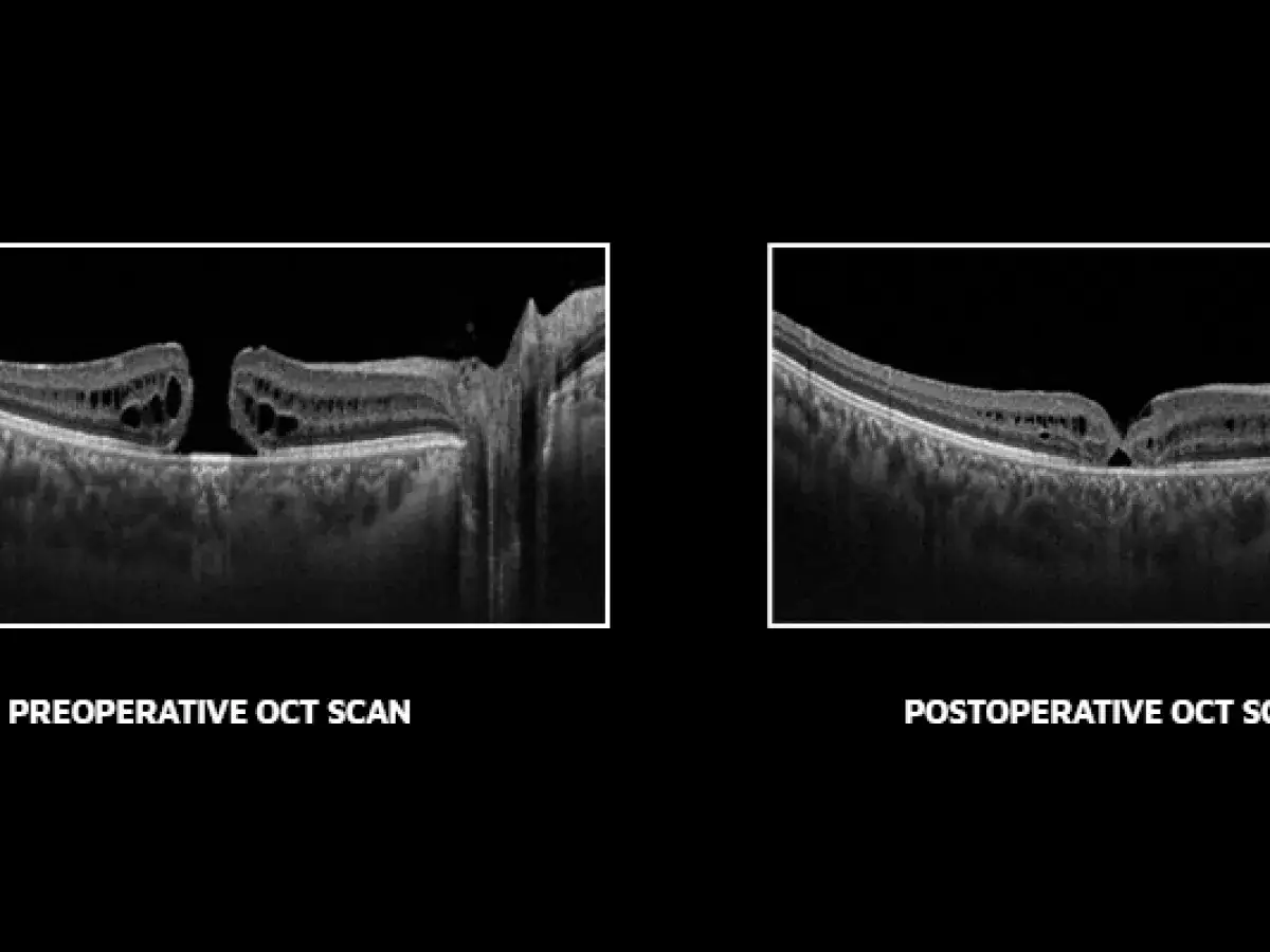 OCT pre e post-operatorio: il foro oculare appare più piccolo dopo l'intervento.
