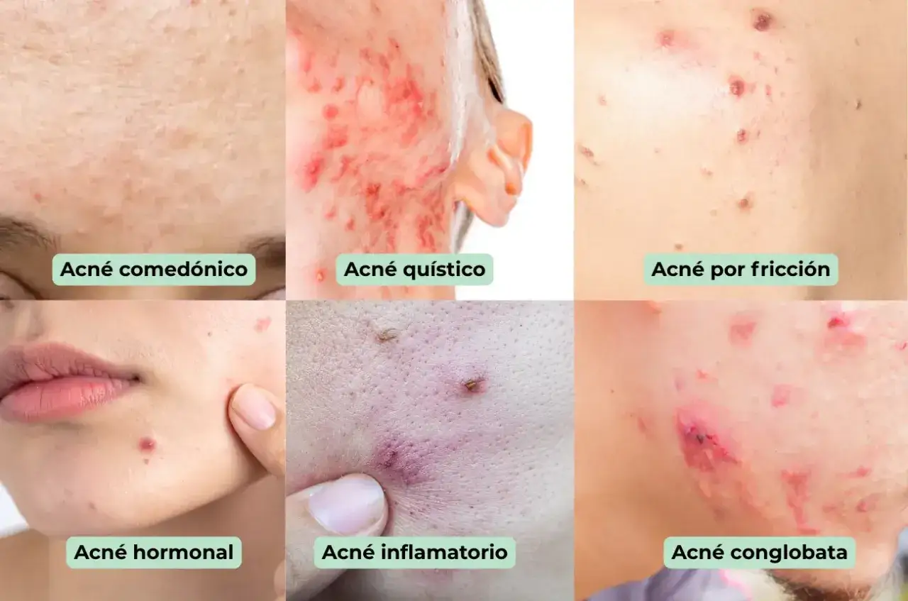 Seis tipos de acn&eacute;: comed&oacute;nico, qu&iacute;stico, por fricci&oacute;n, hormonal, inflamatorio y   conglobata.