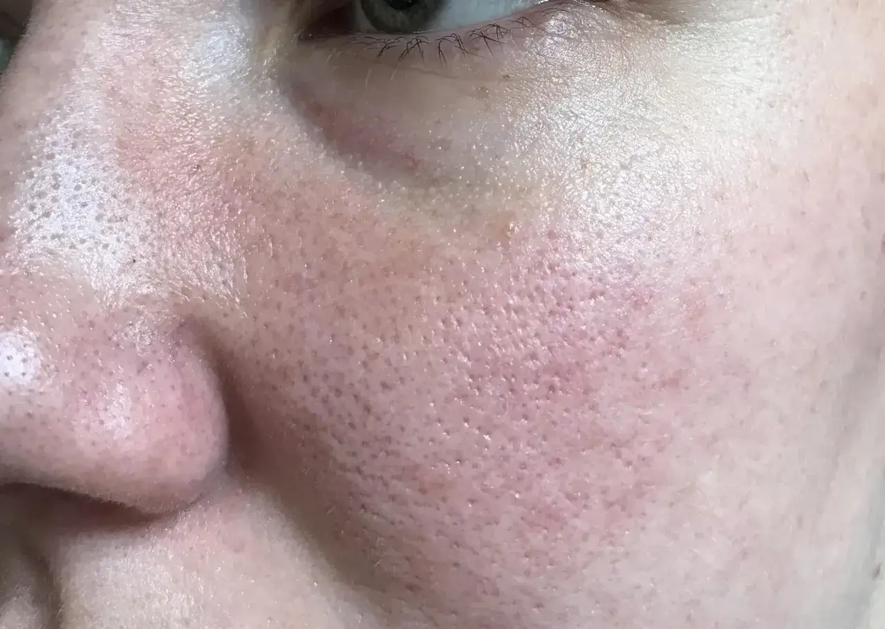 Gros pores dilatés, brillance et rougeurs sur la joue : des signes qui aident à savoir si on a la peau grasse.