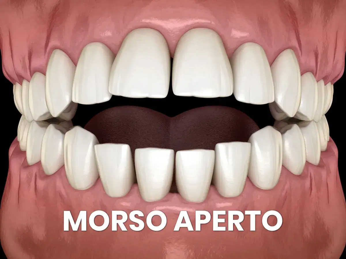 Denti con morso aperto, una condizione che può interessare anche i bambini.