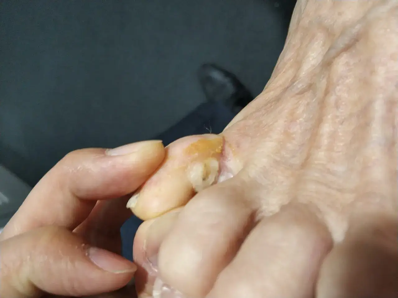 Gros plan sur un pied, montrant un oeil de perdrix douloureux entre deux orteils.