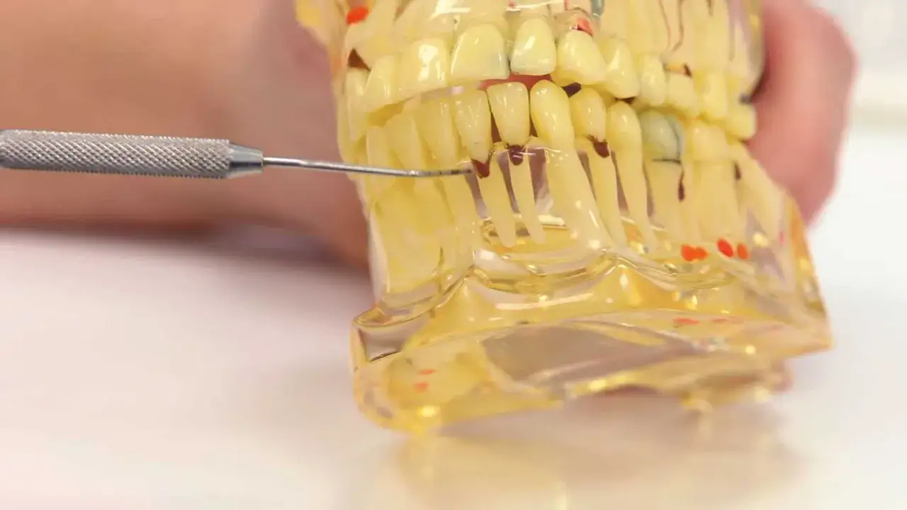 Model szczęki z narzędziem dentystycznym, pokazujący postępujące choroby jamy ustnej.