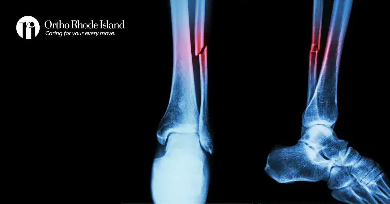 RTG pokazuje złamanie kości piszczelowej i strzałkowej, z widocznym zrostem kości w trakcie gojenia.