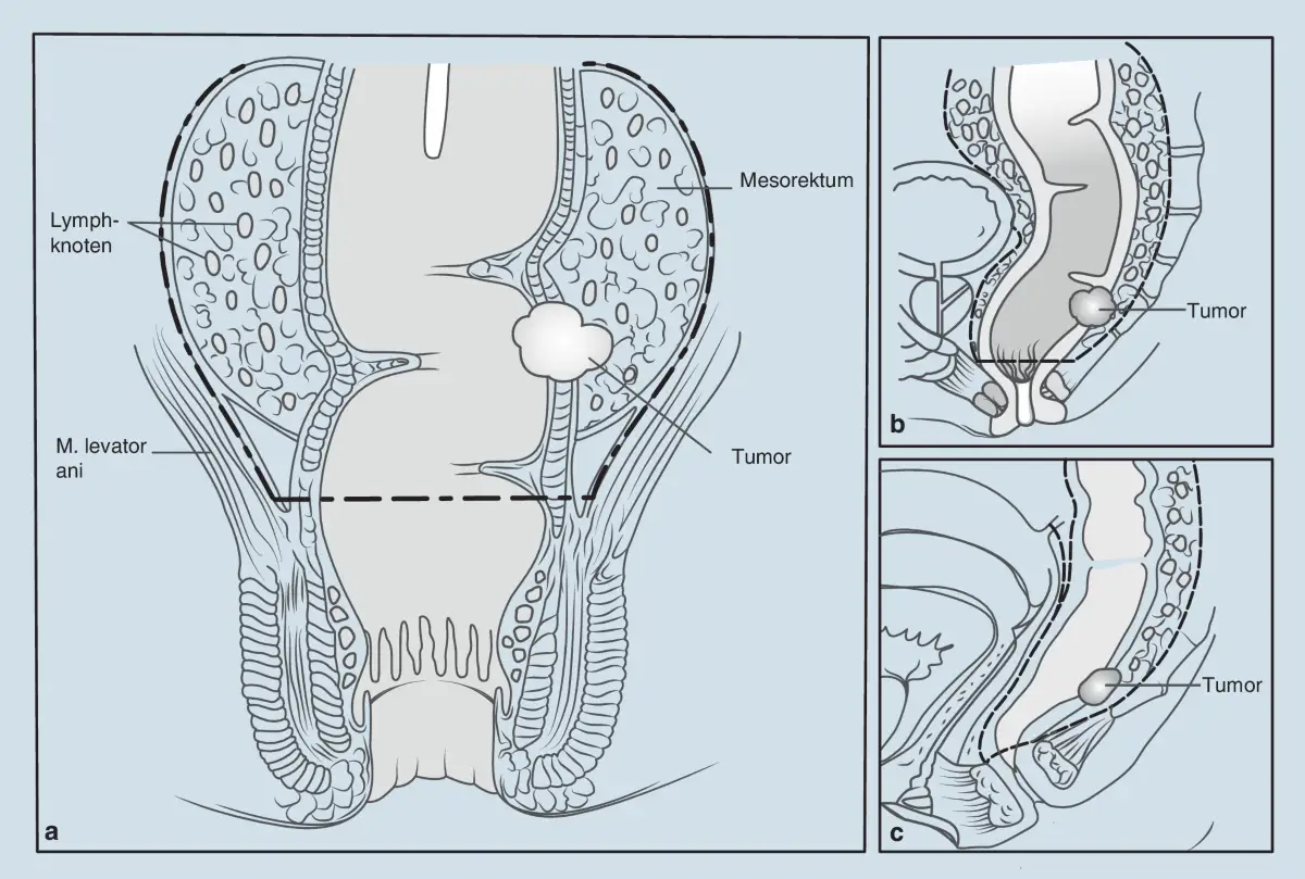 Illustrationen zeigen einen Tumor im Mesorektum, Lymphknoten und den M. levator ani. Die mesorektale Faszie wird als Begrenzung f&uuml;r die chirurgische Entfernung dargestellt.