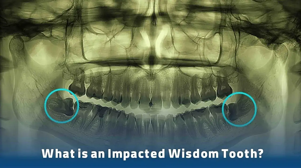 Radiografía dental muestra muelas del juicio impactadas, una causa común de ganglio inflamado.
