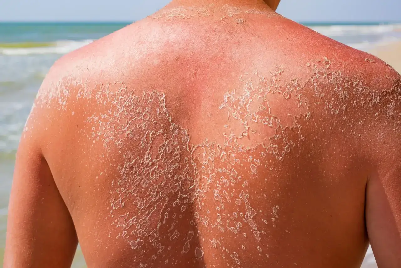 Dos au soleil, le dos rougit et p&egrave;le. La peau qui p&egrave;le apr&egrave;s un coup de soleil peut durer plusieurs jours.