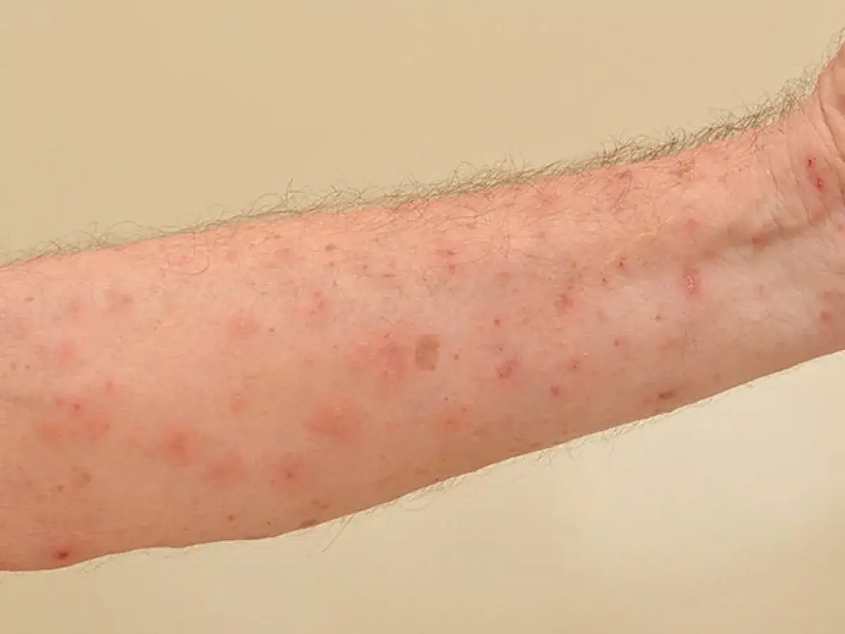 Brazo con erupción roja y picazón, posible reacción a ácaros alergia en la piel.
