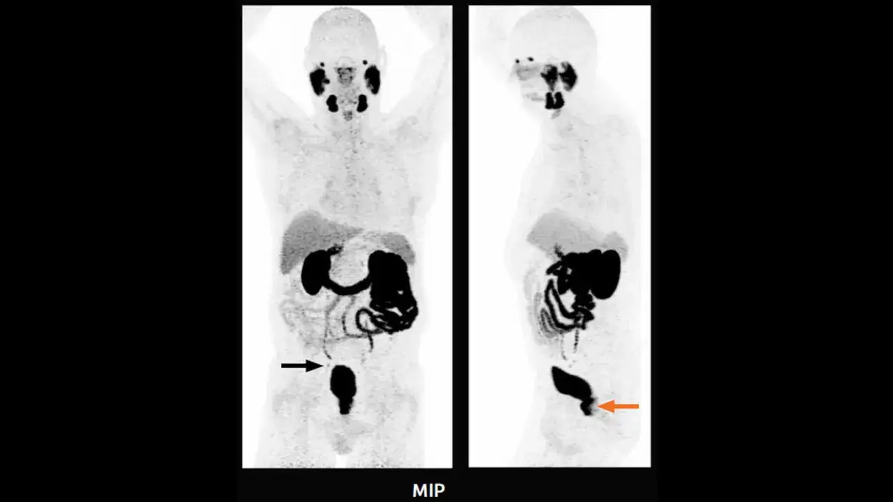 PET CT Bilder zeigen auffällige Bereiche im Becken, die auf Metastasen hindeuten könnten. Ein schwarzer Pfeil markiert einen Bereich, ein oranger Pfeil einen anderen.