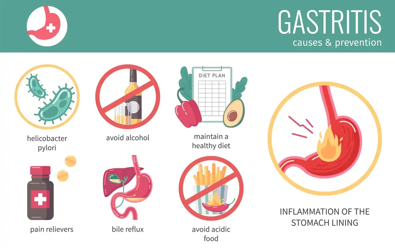 Gastritis-Ursachen: Helicobacter pylori, Alkohol, ungesunde Ernährung, Schmerzmittel, Gallereflux. Entzündung der Magenschleimhaut. Gastritis wird nicht besser trotz Pantoprazol?