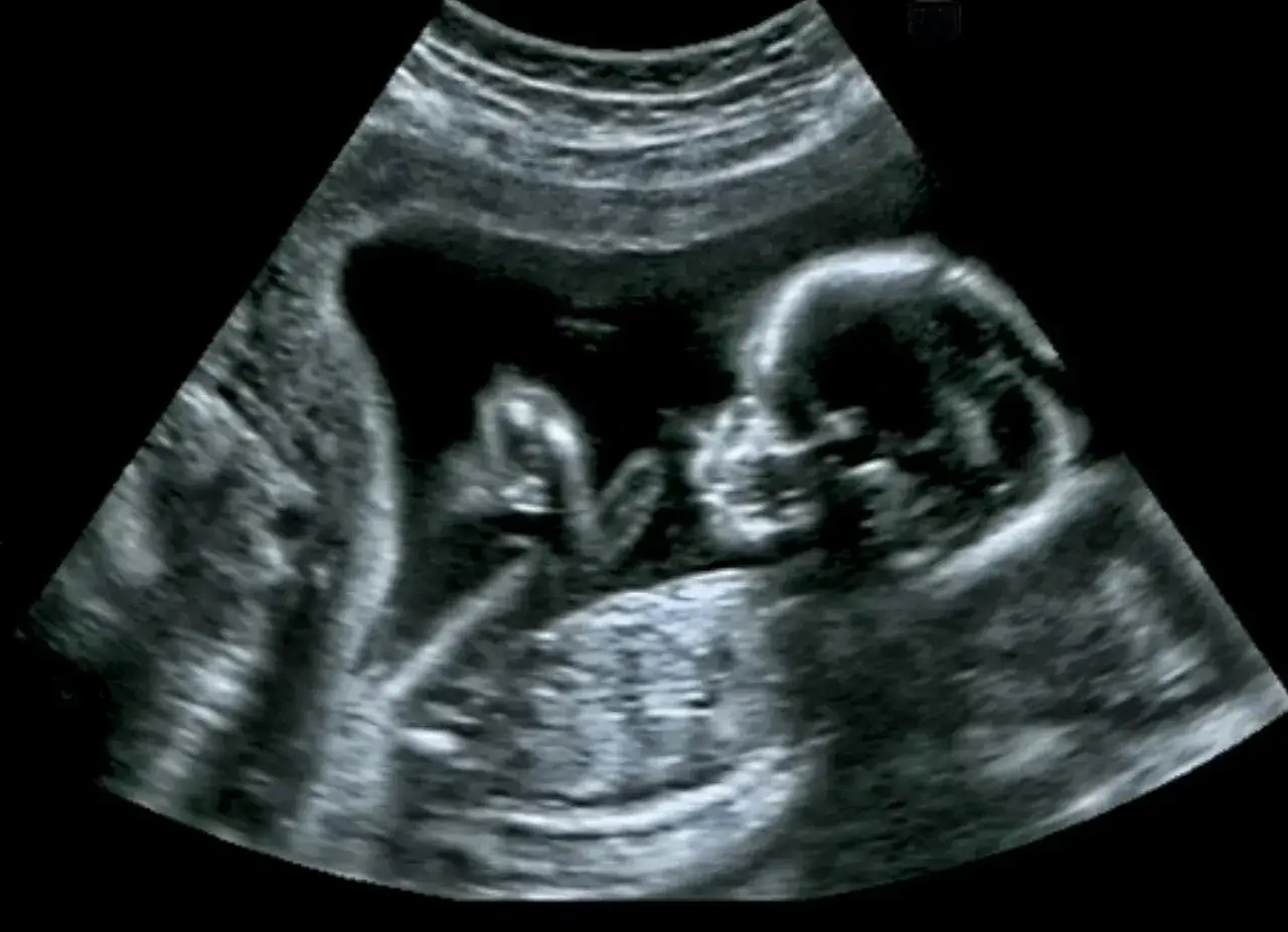 Ultraschallbild eines Babys im Mutterleib, 17. SSW. Man erkennt das Gesicht und die Hände des Kindes.