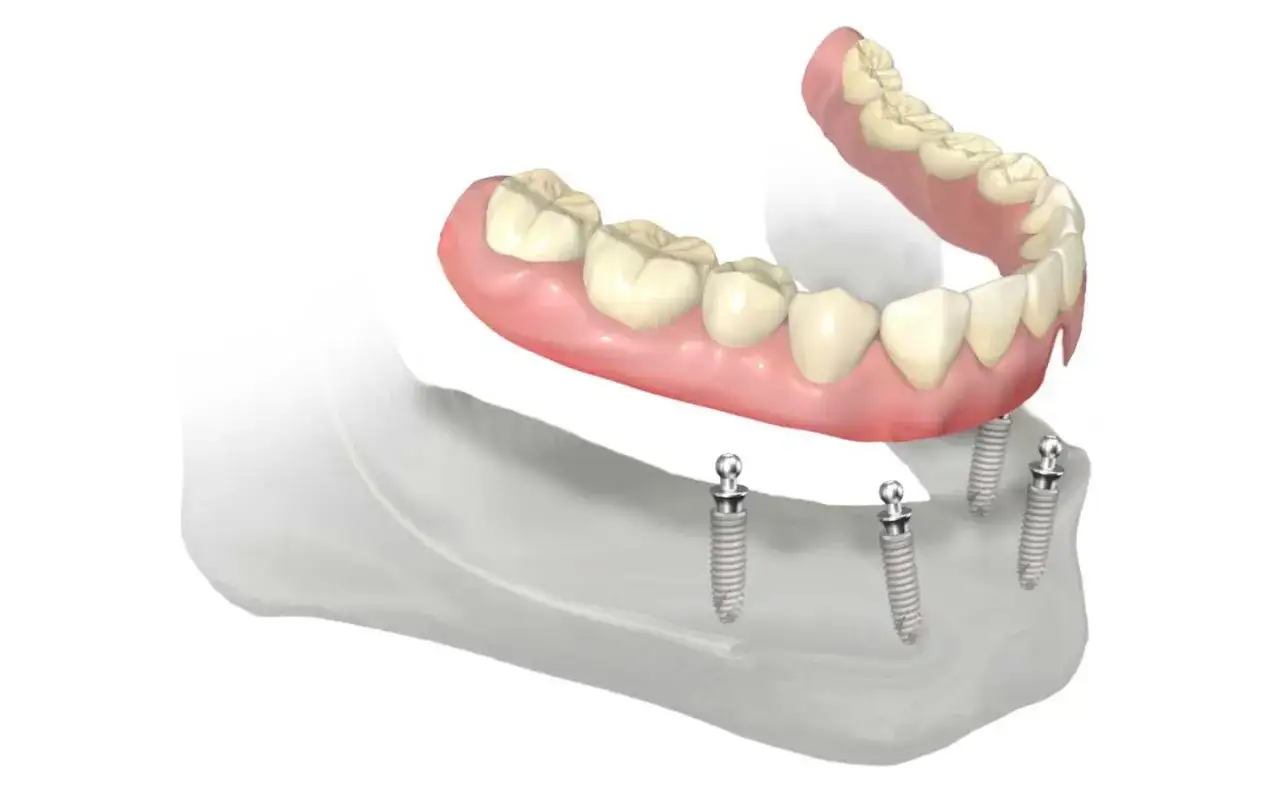 Immagine di una protesi dentale fissata su impianti. La dentiera mi fa vomitare, ma questa soluzione sembra più stabile.