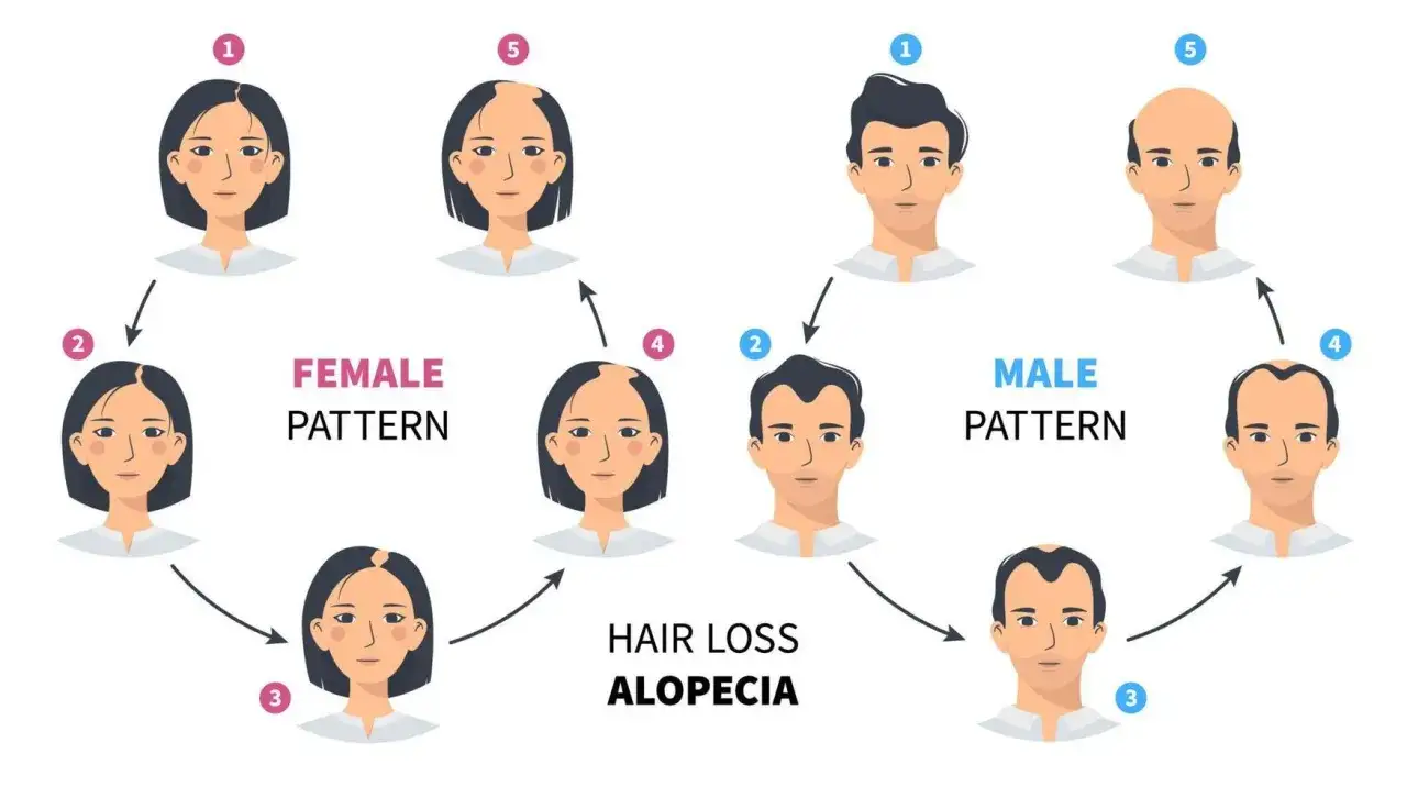 Ilustración que muestra la progresión de la alopecia androgénica en hombres y mujeres, desde la pérdida leve hasta la calvicie total.