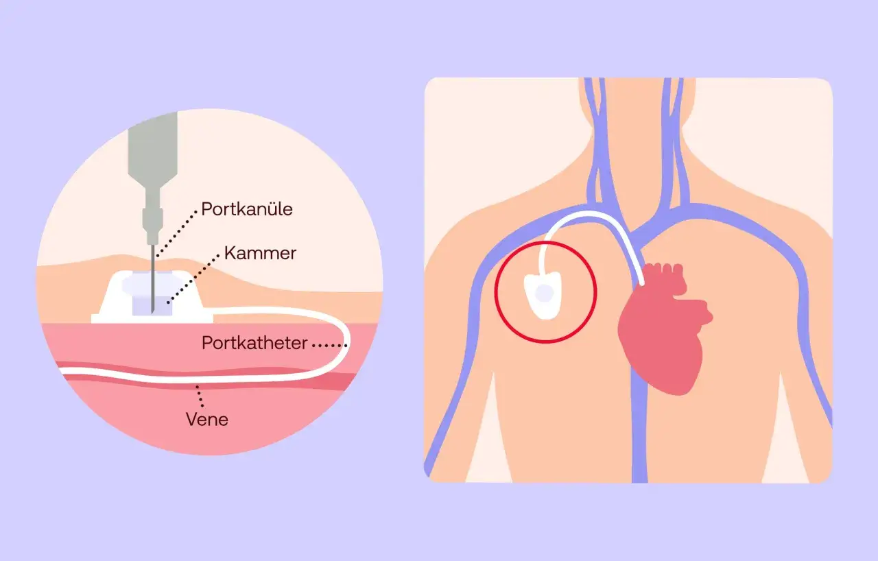 Illustration zeigt einen Portkatheter, der in eine Vene eingeführt wird. Ein Port vene ist ein kleines Reservoir unter der Haut.