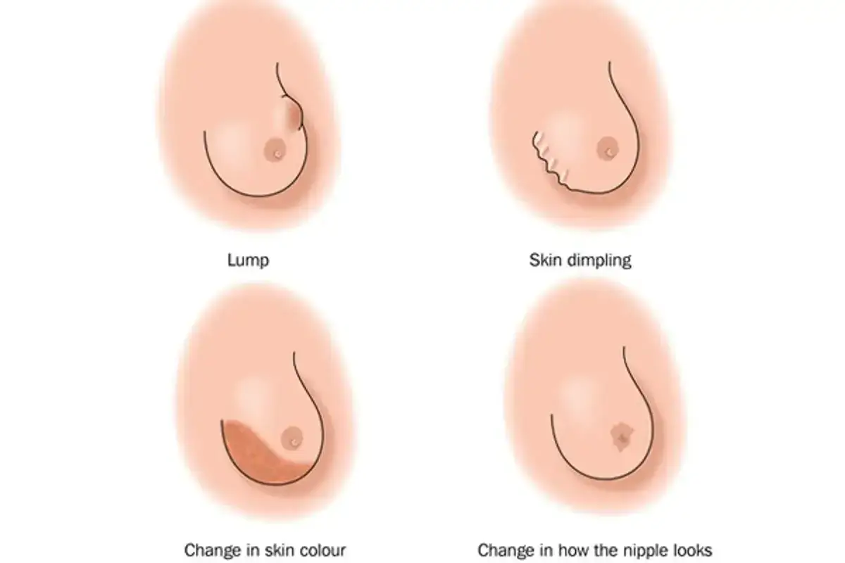 Illustrazioni mostrano tumore al seno sintomi visibili: nodulo, pelle incavata, cambio colore pelle, alterazione capezzolo.