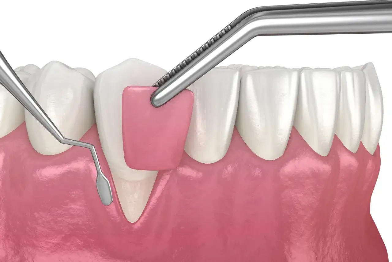 Strumenti dentali lavorano sulle gengive, forse per un trattamento con laser gengive.
