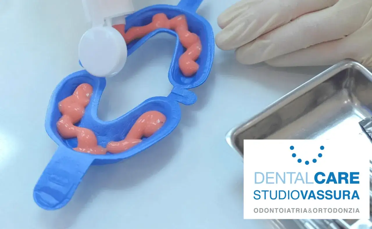 Preparazione per un trattamento fluoro denti: un'impronta dentale blu riempita di materiale rosa.