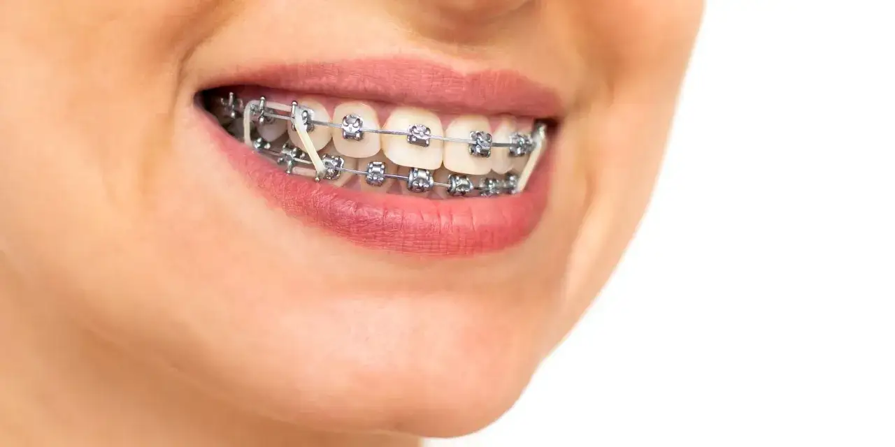 Sorriso con apparecchio ortodontico e elastici. A volte gli elastici apparecchio fanno male, ma sono necessari per un sorriso perfetto.