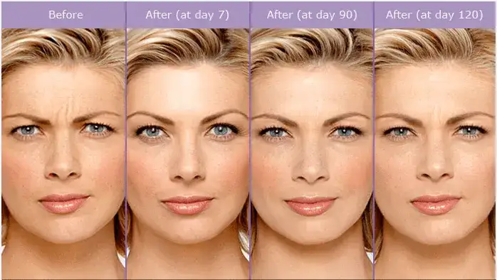 botox forehead before after timeline