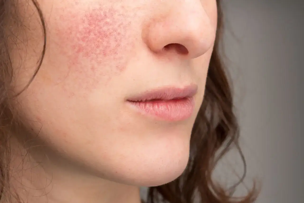 Widoczna czerwona wysypka na policzku, która może być objawem problemów skórnych.