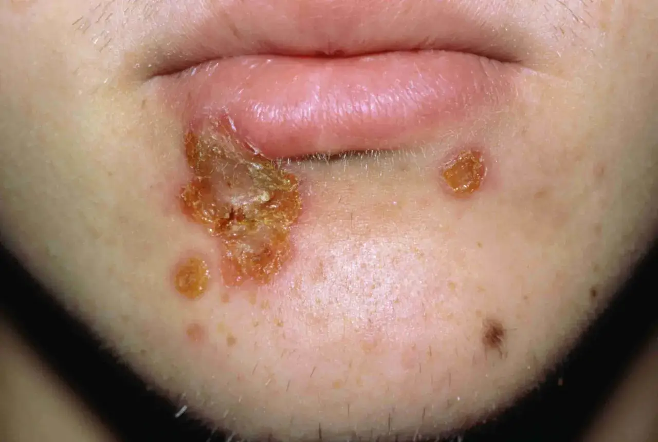 Lippenherpes mit Krustenbildung, der ein unangenehmes Gefühl des Brennen unter der Haut verursacht. Mehrere Bläschen sind sichtbar.