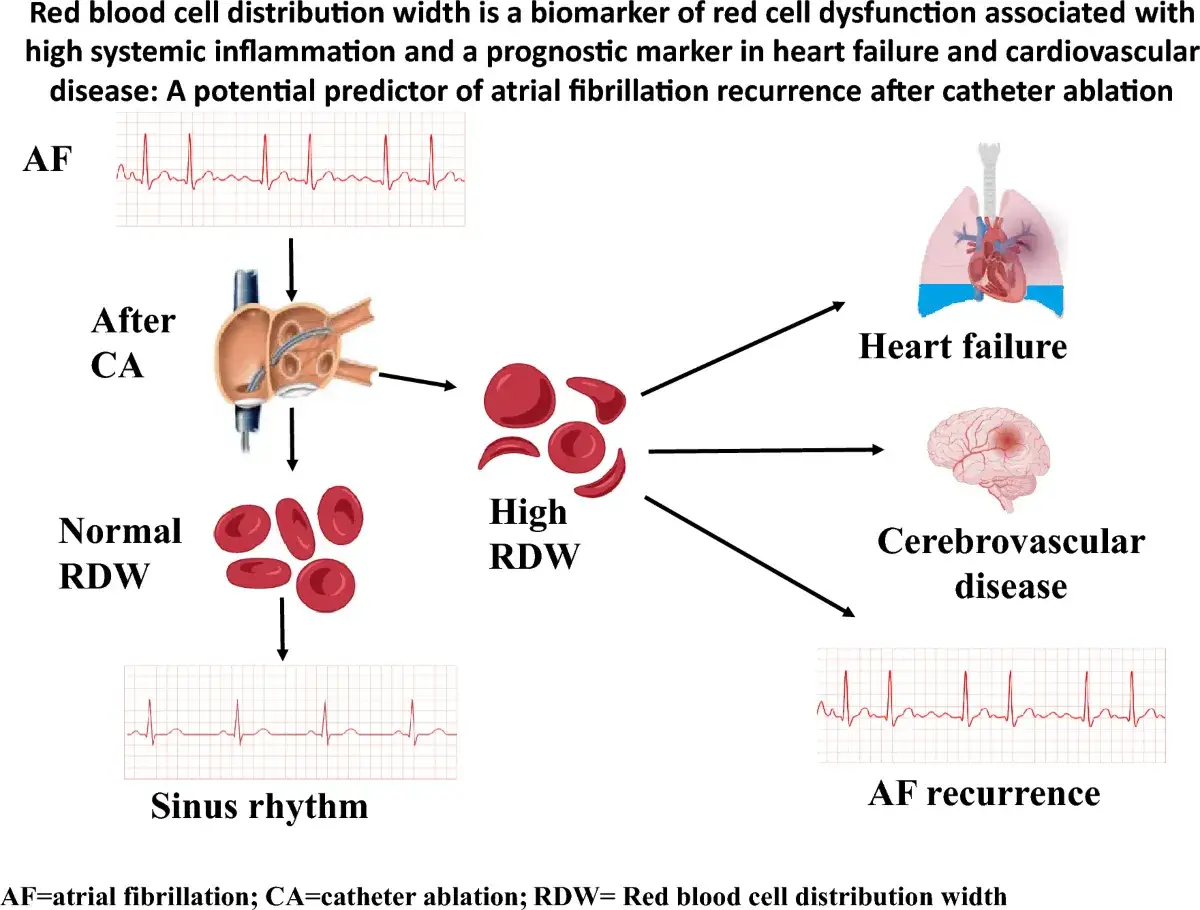 Wysokie RDW (red blood cell distribution width) wiąże się z niewydolnością serca, chorobami mózgu i nawrotami AF po ablacji.