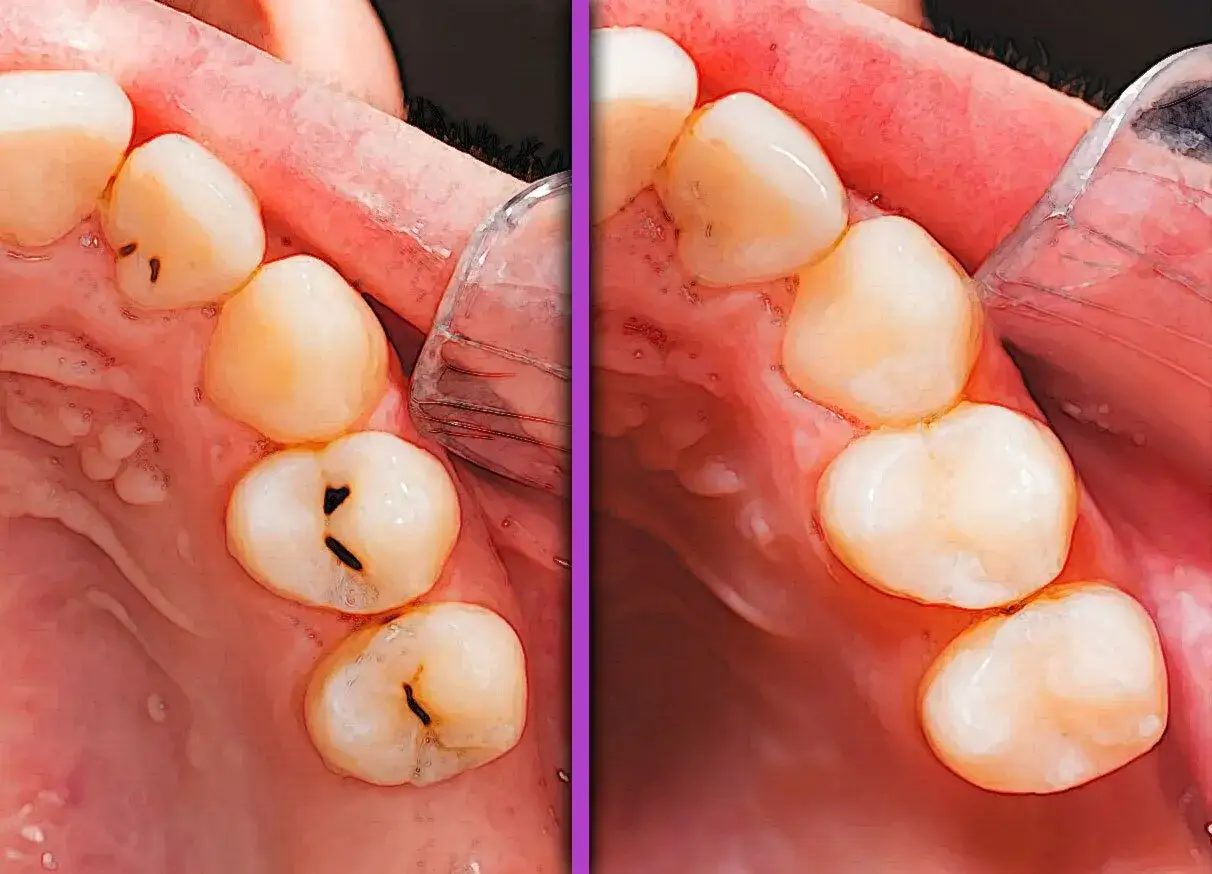 Confronto tra denti: a sinistra, solchi denti con carie evidenti; a destra, denti restaurati e sani.