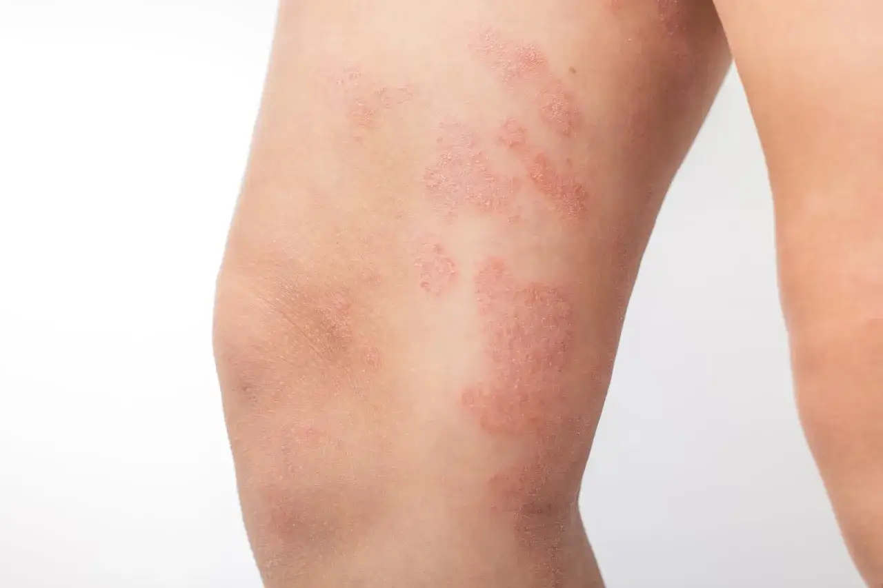 Plaques rouges et squameuses sur la cuisse, indiquant un **eczéma cuisse**. La peau est irritée et présente des zones sèches.