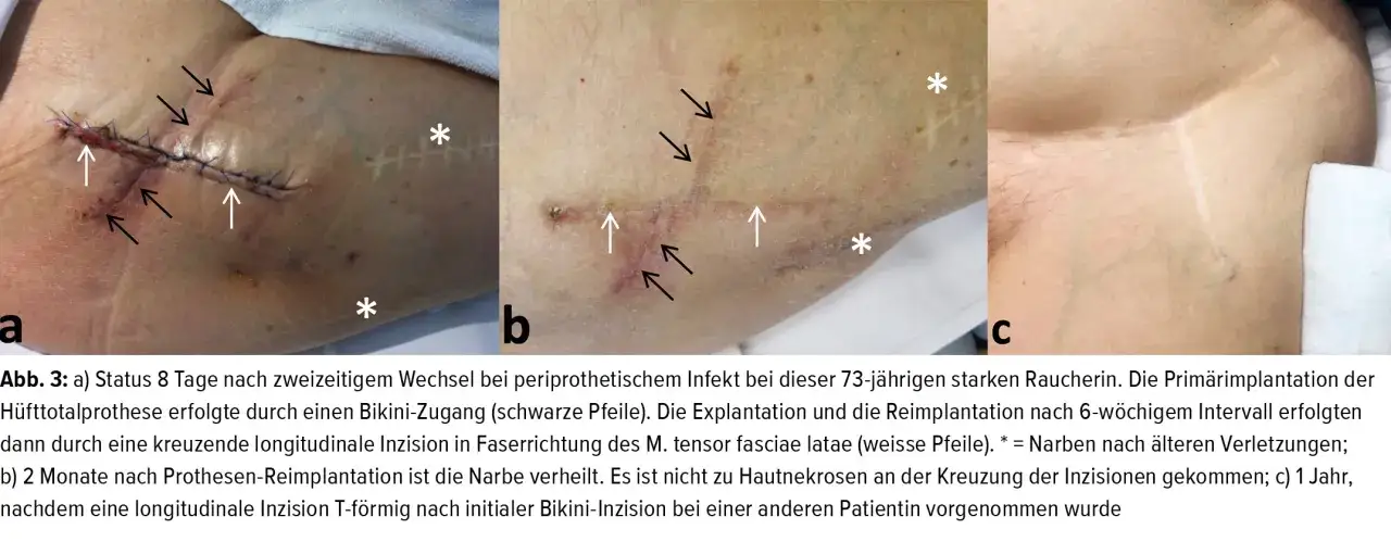 a) Narbe nach H&uuml;ft-OP mit N&auml;hten und Pfeilen, b) Heilende Narbe nach Oberschenkelhalsbruch-OP, c) &Auml;ltere Narbe.