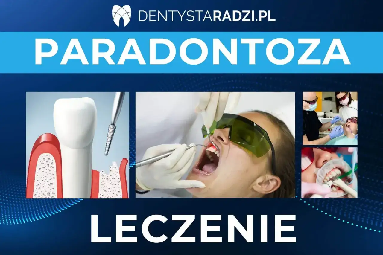 Grafika przedstawia leczenie paradontozy. Widoczne są ilustracje zębów z ubytkami, zabiegi stomatologiczne z użyciem narzędzi i lasera.