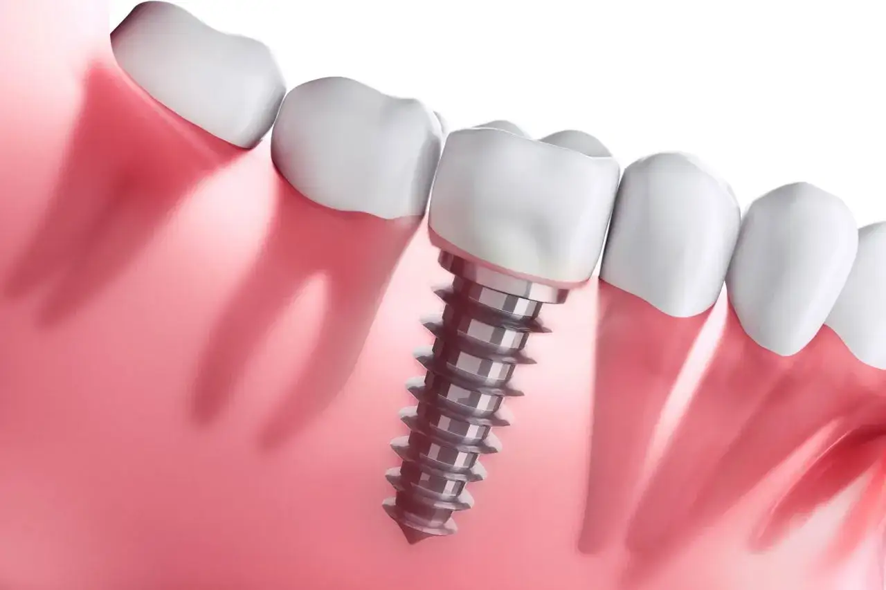 Implant zęba wkręcony w kość, widoczny obok naturalnych zęb&oacute;w. To kluczowy element nowoczesnej stomatologii, kt&oacute;ry może być widoczny na badaniach takich jak rezonans.
