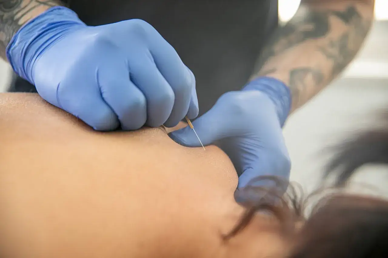 H&auml;nde mit blauen Handschuhen f&uuml;hren eine feine Nadel in die Schulter eines Patienten ein. Einblicke in positive dry needling erfahrungsberichte.