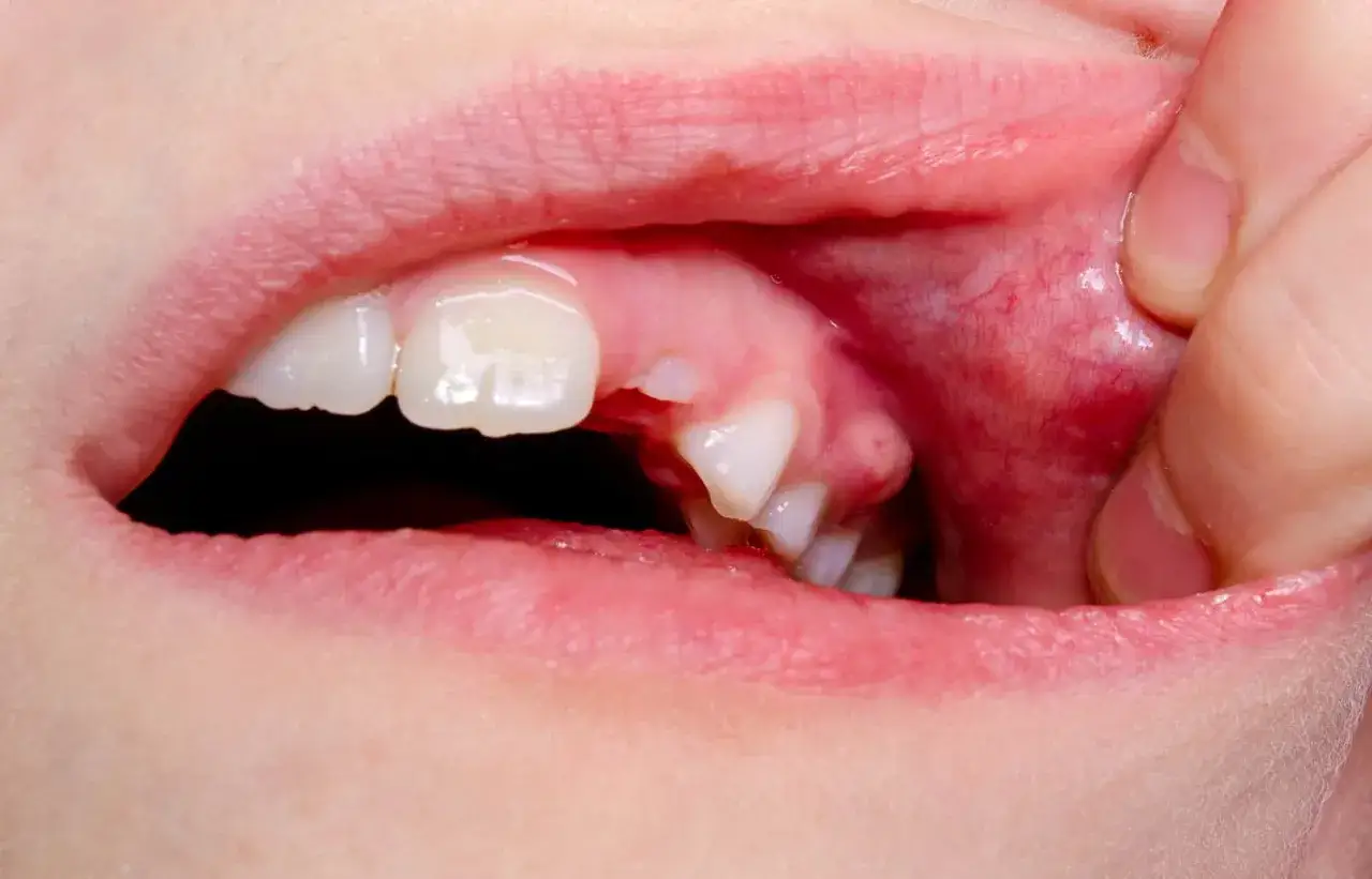 Gengiva arrossata e gonfia vicino a un dente, indicativo di un ascesso mascellare.