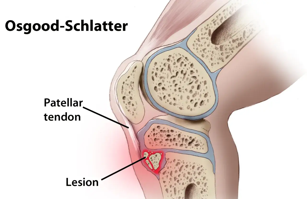 Ilustracja przedstawia kolano z zaznaczonym zapaleniem przyczepu więzadła rzepki, czyli Osgood-Schlatter.