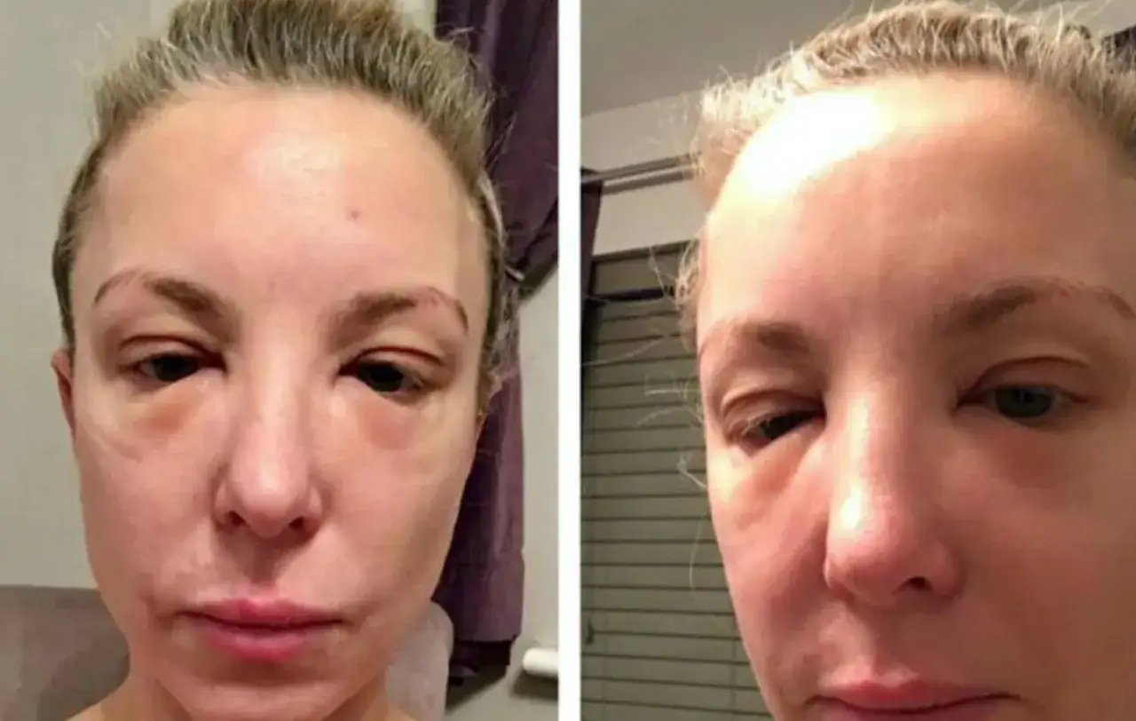 F&ouml;re- och efterbilder visar en kvinna med kraftig svullnad runt &ouml;gonen efter fillers.