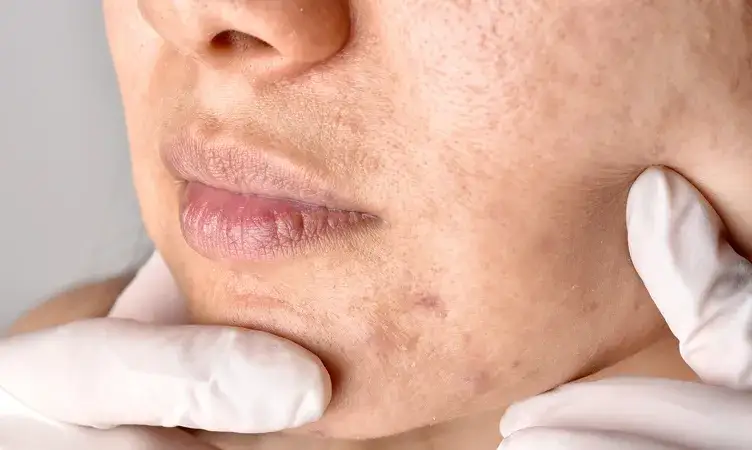 dermatolog gabinet leczenie trądziku