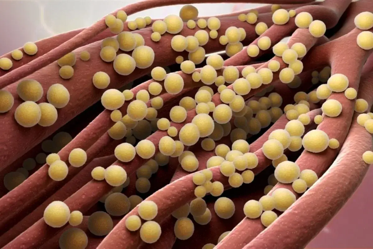 Ingrandimento di fibre rosse con batteri sferici gialli, che ricordano un'infezione naso stafilococco.