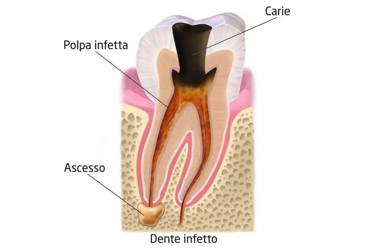Ascesso dentale: una bolla sulla gengiva indica un dente infetto con polpa e radici compromesse dalla carie.