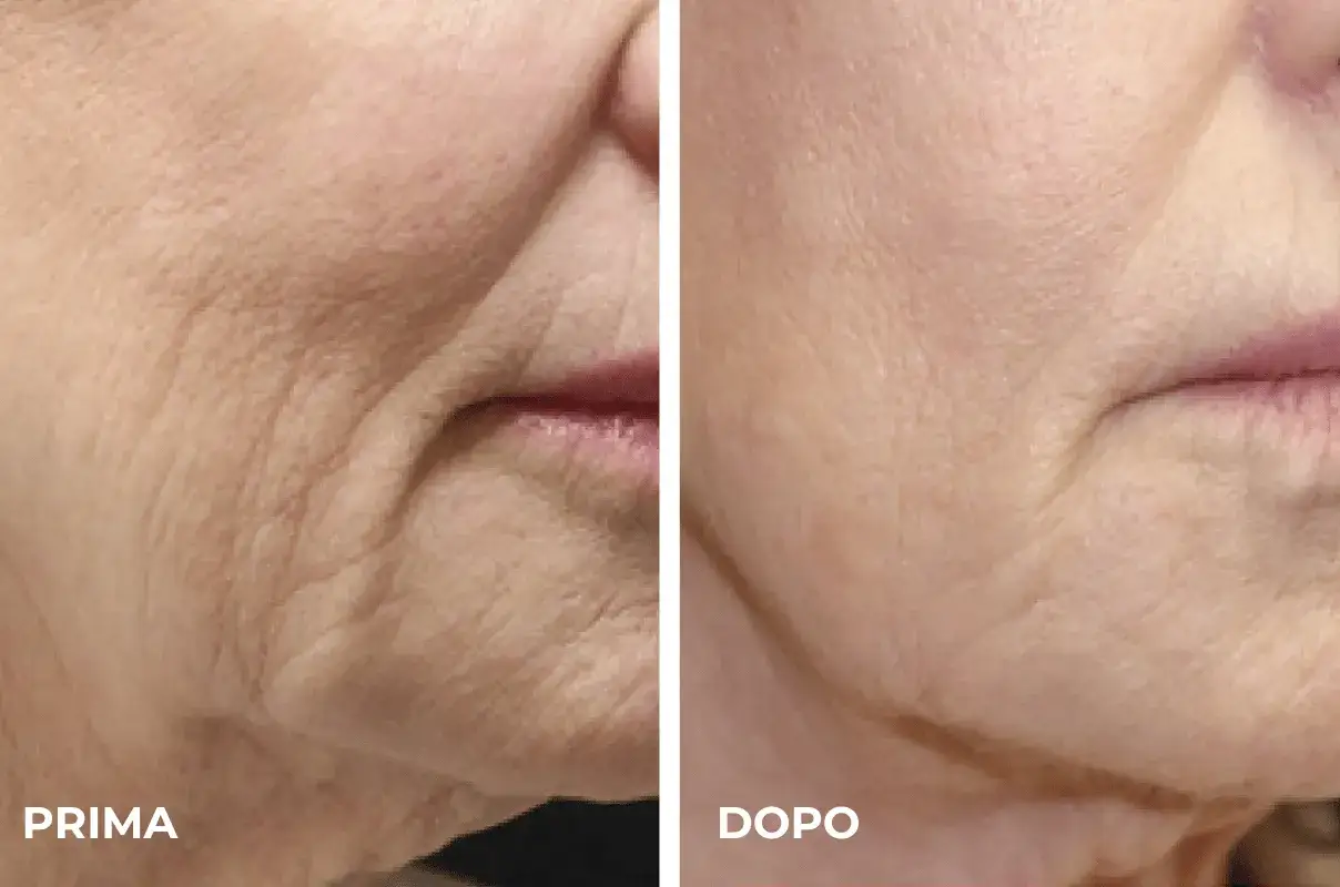 Prima e dopo un trattamento laser viso rughe: la pelle appare visibilmente più liscia e giovane.