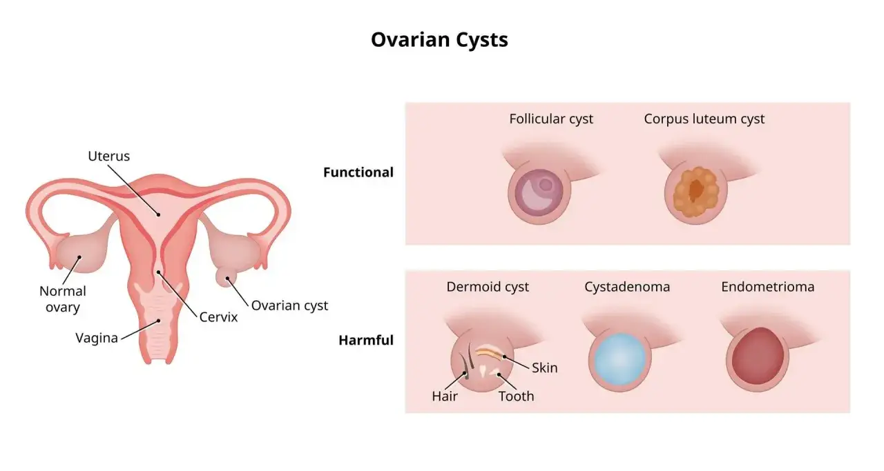 Ovarialzyste Diagramm