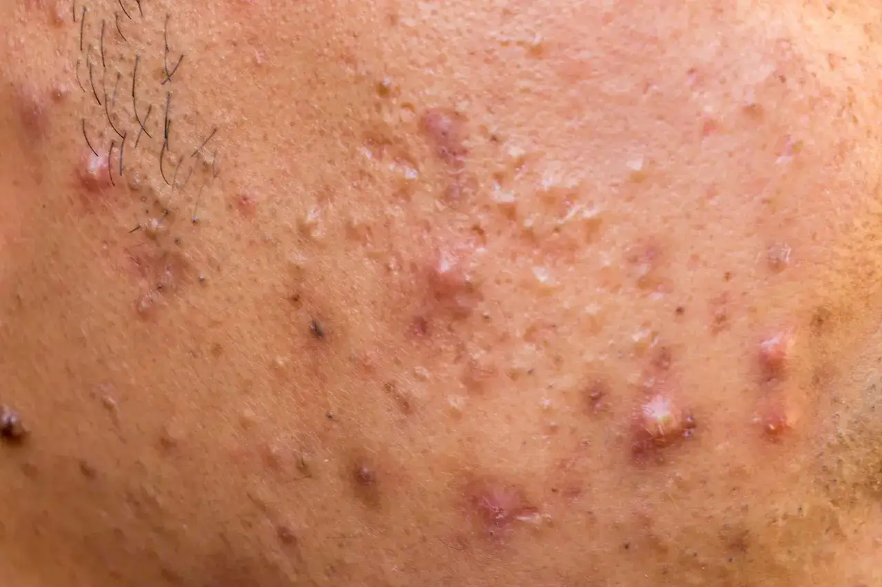 Piel con m&uacute;ltiples p&uacute;stulas, comedones y cicatrices, indicativo de **acn&eacute; conglobata**. Se aprecian fol&iacute;culos pilosos y marcas de inflamaci&oacute;n.