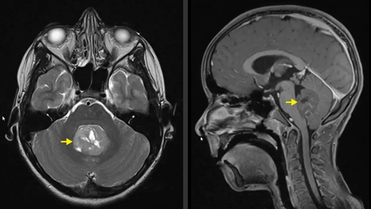 MRT-Aufnahmen zeigen einen Tumor im Kleinhirn eines Kindes, der auf ein Neuroblastom hindeutet.
