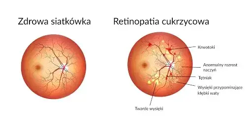 schemat oka z widocznymi naczyniami krwionośnymi, wpływ cukrzycy na wzrok