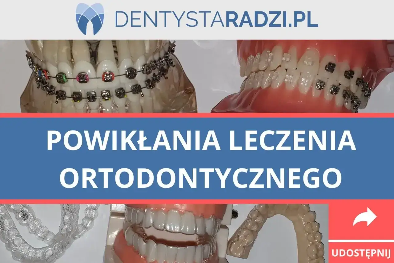 Modele szczęk z aparatami ortodontycznymi, w tym tradycyjnymi zamkami i przezroczystymi nakładkami. Temat: powikłania leczenia ortodontycznego, np. afty od aparatu ortodontycznego.