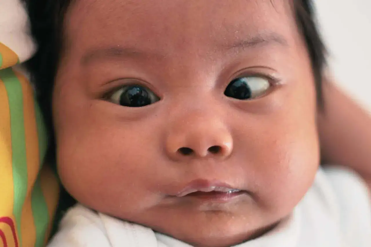 Primo piano di un neonato con strabismo. Uno sguardo curioso che esplora il mondo, anche se gli occhi non puntano nella stessa direzione.
