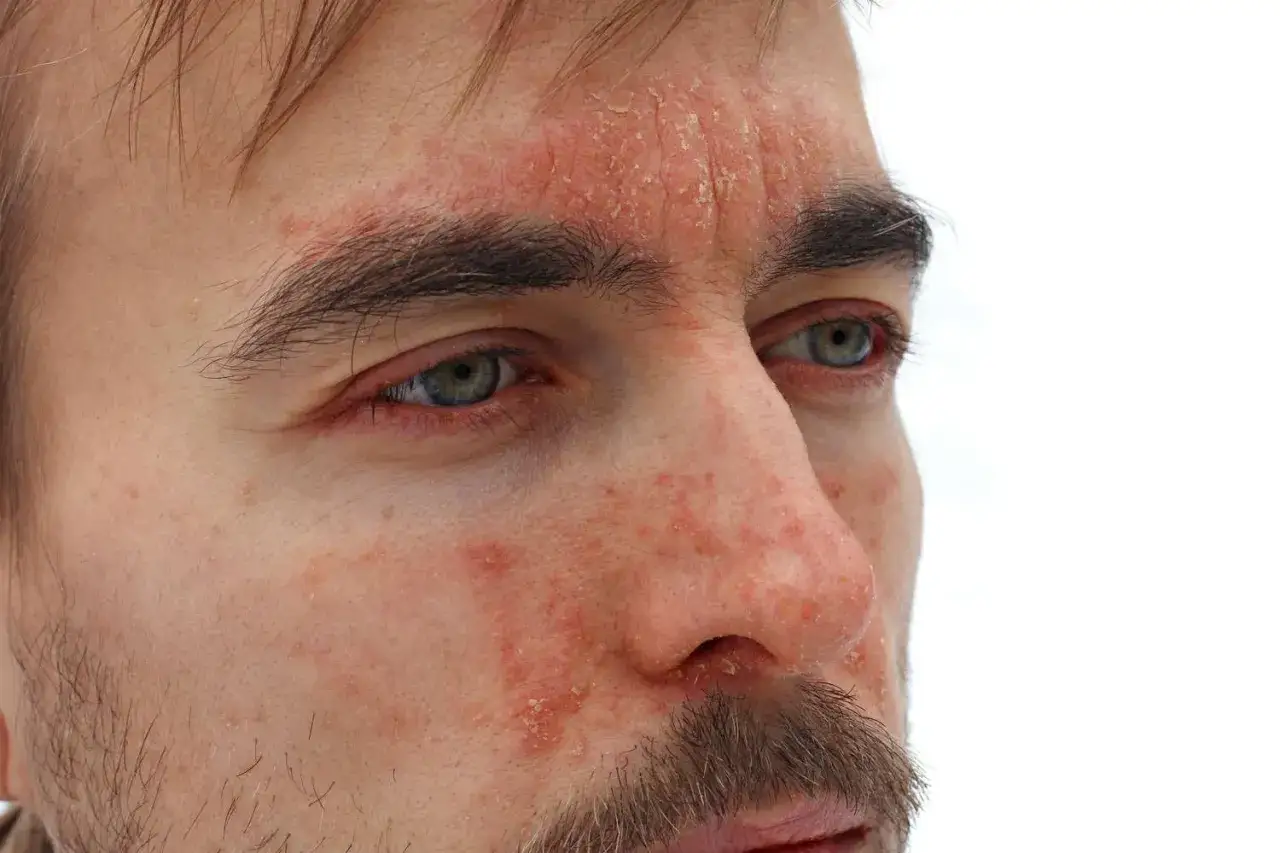 Närbild på en mans ansikte med synlig psoriasis i ansiktet, särskilt runt ögonen och på pannan.