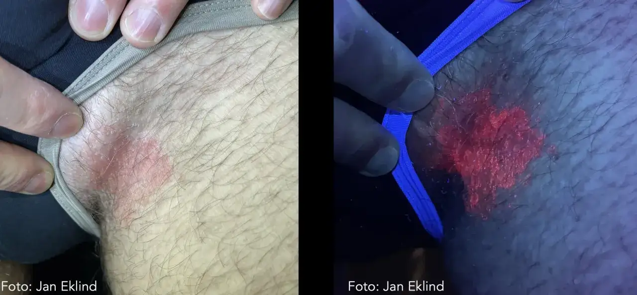 Två bilder visar en hudrodnad, den högra bilden är tagen i UV-ljus där rodnaden lyser intensivt rött, vilket indikerar svamp på huden.