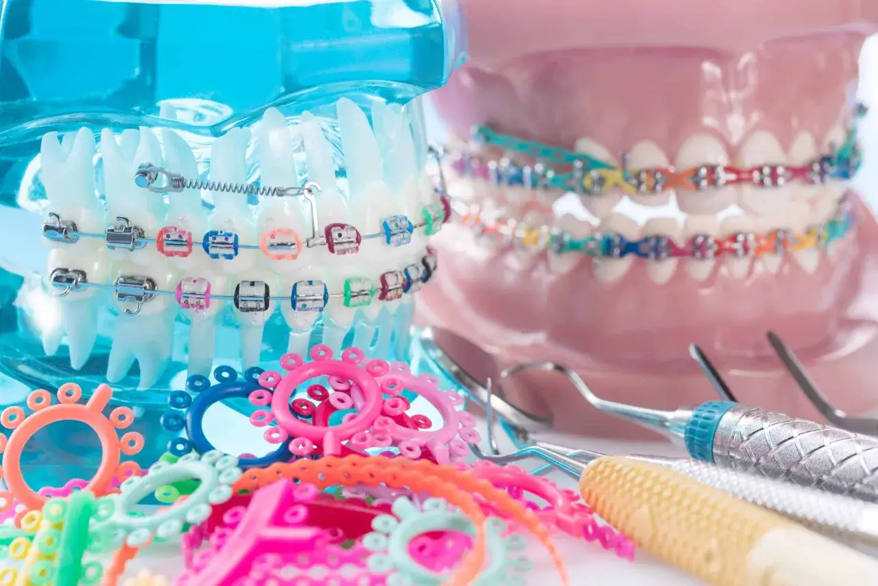 Kolorowe ligatury i metalowe zamki na modelach szczęk, obok narzędzi dentystycznych. To aparat stały ceramiczny w akcji, gotowy do prostowania zębów.