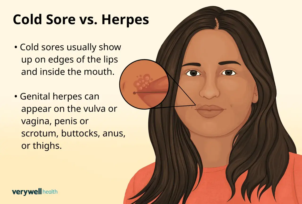 Mujer con herpes labial. El herpes dentro de la boca puede requerir tratamiento.